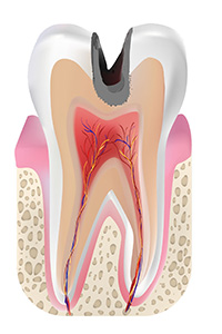C2：象牙質の虫歯