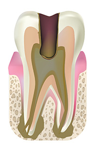 C4：歯冠（歯の頭のぶぶん）が崩壊した虫歯
