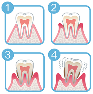 歯周病メカニズム